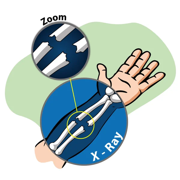 Illustration First Aid person ray x arm, fractured bone. Ideal for catalogs, informative and medical guides — ストックベクタ