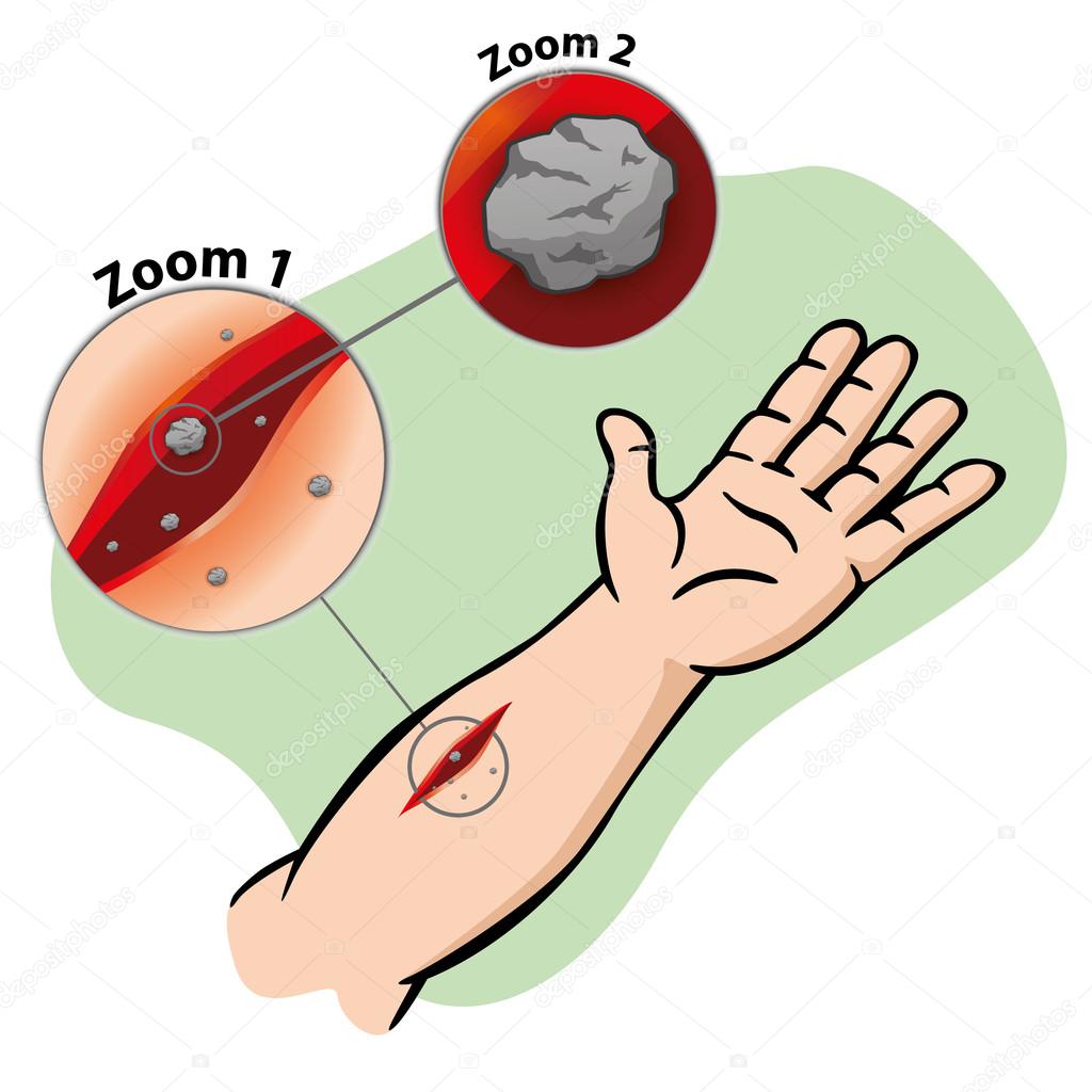 Illustration First Aid person arm cutting wound hole. Ideal for catalogs, informative and medical guides