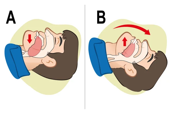 Erste-Hilfe-Reanimation (cpr), Reinigung der Atmung, Positionierung. zur Wiederbelebung. ideal für Schulungsmaterialien, Kataloge und institutionelle — Stockvektor