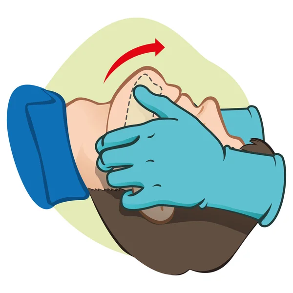 Reanimación de primeros auxilios (RCP), limpieza de la respiración, posicionamiento con guantes. Para resucitación. Ideal para materiales de formación, catálogos e instituciones — Vector de stock