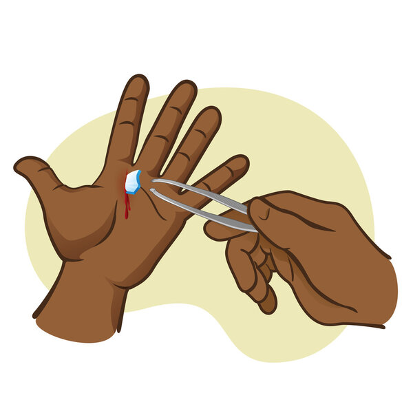 Person injured hand with broken glass, pulling with forceps African descent. Ideal for catalogs, informative and institutional guides