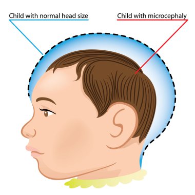 Illustration of a newborn baby with microcephaly disease caused by Zika virus. Ideal for informational and institutional related sanitation and medicine clipart