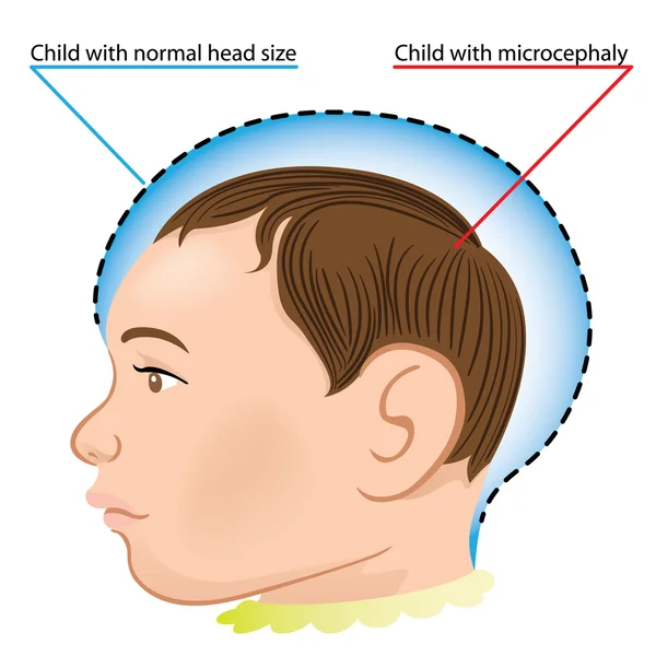 Illustration of a newborn baby with microcephaly disease caused by Zika virus. Ideal for informational and institutional related sanitation and medicine — Stock Vector