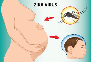 Illustration of a pregnant with Zika Virus and newborn baby with microcephaly disease, Aedes. Ideal for informational and institutional related sanitation and medicine