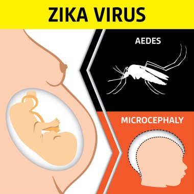 Illustration of a pregnant with Zika Virus and newborn baby with microcephaly disease, Aedes. Ideal for informational and institutional related sanitation and medicine