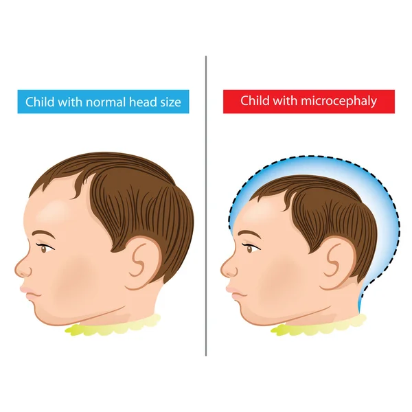 Illustration of a newborn baby with microcephaly disease caused by Zika virus. Ideal for informational and institutional related sanitation and medicine — Stock Vector