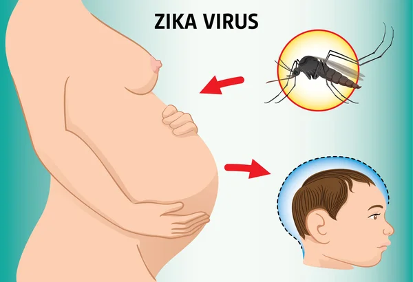 Illustration d'une femme enceinte du virus Zika et d'un nouveau-né atteint de microcéphalie, Aedes. Idéal pour l'assainissement et la médecine informationnelle et institutionnelle — Image vectorielle