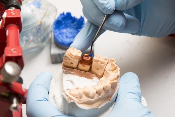 elinde bir diş implantı üzerinde çalışan diş hekimi