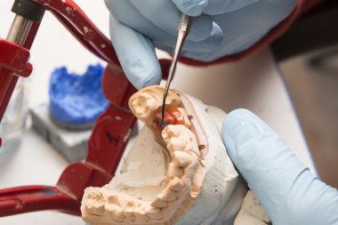 elinde bir diş implantı üzerinde çalışan diş hekimi