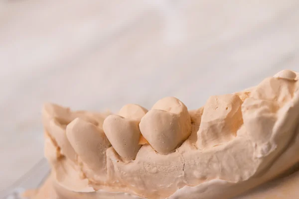 Diş kalıp protez dişler için