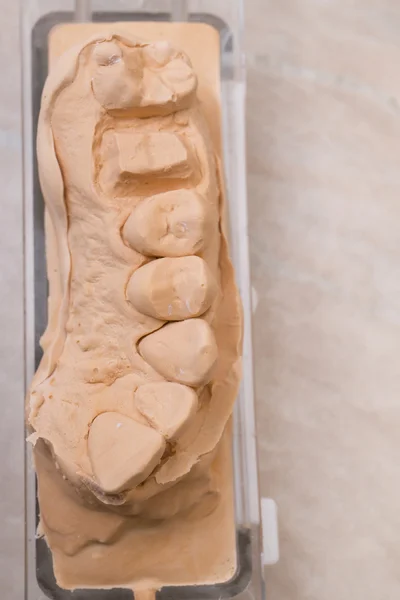 Diş kalıp protez dişler için