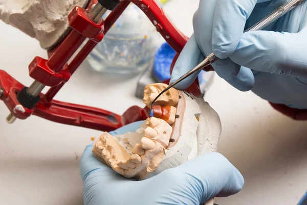 elinde bir diş implantı üzerinde çalışan diş hekimi