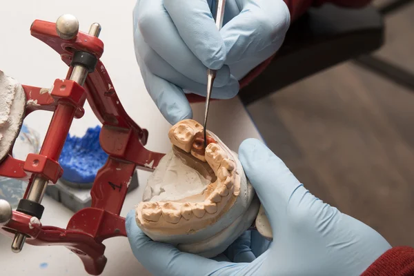 elinde bir diş implantı üzerinde çalışan diş hekimi