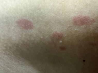 İnsan vücudunda kırmızı noktalar, yanıklar, bakteriler, enfeksiyonlar. İlaç, tedavi, kendini tedavi.