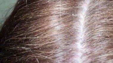 Kepek ve hasarlı kafa derisi olan kirli, dağınık bir saç teli. Mantar cilt enfeksiyonları.