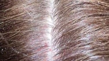 Kepek ve hasarlı kafa derisi olan kirli, dağınık bir saç teli. Mantar cilt enfeksiyonları.