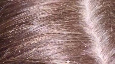 Kepek ve hasarlı kafa derisi olan kirli, dağınık bir saç teli. Mantar cilt enfeksiyonları.