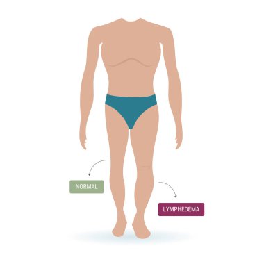 Kahraman insan vücudu normal bacağa kıyasla lenf bezi semptomlarıyla karşılaştırıldığında şişkinlik ve sıvı birikmesini gösterir.