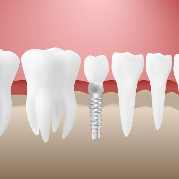 Conjunto de dientes de árbol — Archivo Imágenes Vectoriales