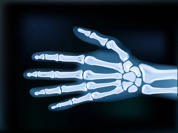 Imagen médica oscura realista de la mano de rayos X en 2D — Archivo Imágenes Vectoriales