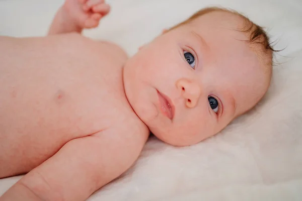 Un bebé con dermatitis seborreica en la cabeza descansa sobre una sábana blanca. guardería. — Foto de Stock