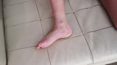 bacağından alçı çıkarılmış, ameliyat ve kir sonrası yaya olarak yara izleri var.