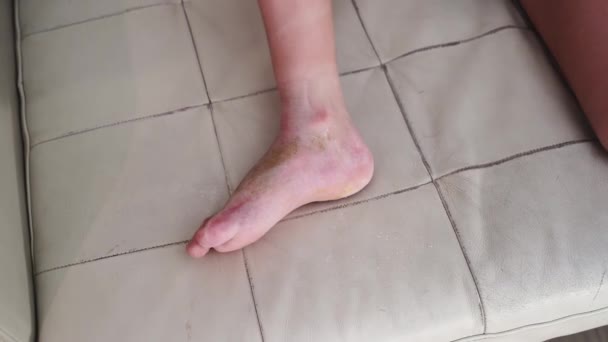 Gips verwijderd uit been, littekens op voet na gebruik en vuil — Stockvideo