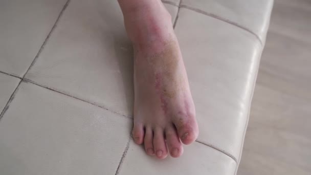 Gips verwijderd uit been, littekens op voet na gebruik en vuil — Stockvideo