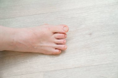 Sıra dışı ayak. Bacağında çok küçük bir parmak var. ortopedik anormallikler. 