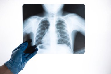Mavi eldivenli bir doktorun ellerinde kaburga ve akciğer röntgenleri. Doktor zatürree için resmi inceliyor..