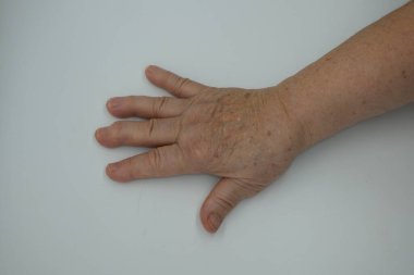 Elin iltihaplı ve deforme olmuş parmak eklemlerini gösteriyor. Kemik iltihabı, eklem iltihabı ve ciltteki yaş lekeleri, beyaz arka planda eğitim ve tanı için yararlı..