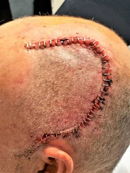 Unidentified man recovering from brain surgery after the surgeons removed a tumor from his brain. They used medical staples to close his large wound.