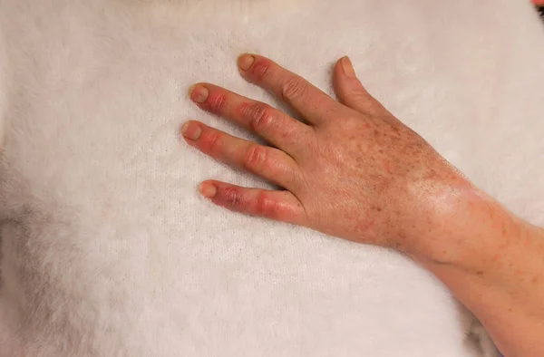 Hand of a 60-year-old woman with Raynaud's syndrome. Reddened and swollen it rests on his chest