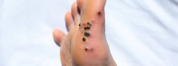 Wounds Removal Warts Black Scars Contagious Skin Illness Foot Medical — Stock Photo, Image