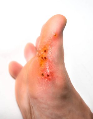 Siğillerin çıkarılmasından kalma yaralar. Kara yaralar. Yürüyerek bulaşıcı deri hastalığı. Tıbbi tedavi fotoğrafı..