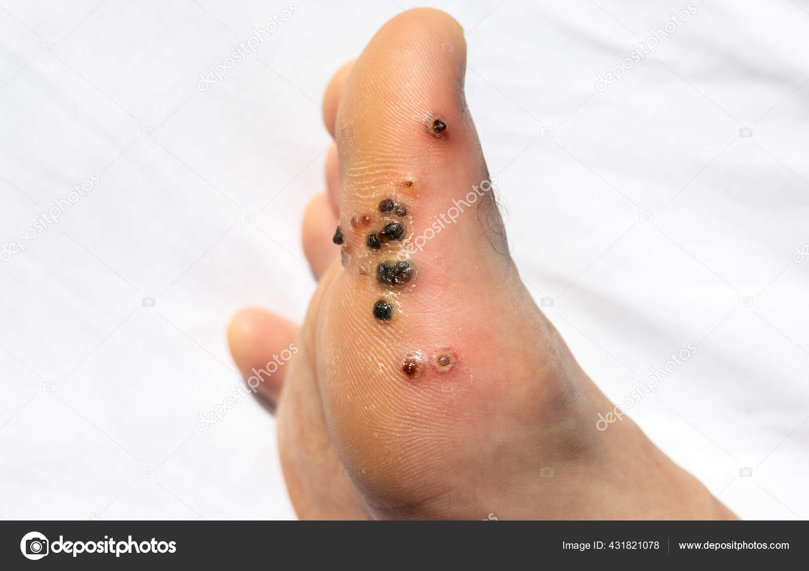 Plantar Wart Turned Black
