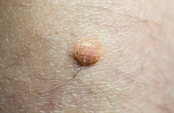 Big Birthmark Skin Medical Health Photo Papillomas Human Body — Stock Photo, Image