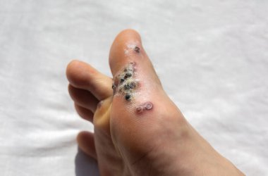 Siğillerin çıkarılmasından kalma yaralar. Kara yaralar. Yürüyerek bulaşıcı deri hastalığı. Tıbbi tedavi fotoğrafı..