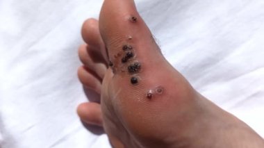 Siğillerin alınmasından kaynaklanan yaralar. Yürüyerek bulaşıcı deri hastalığı. Parmak ucunda pamuk tutan adam. Tıbbi tedavi videosu. Kanla yaralanmış bacak. Yakın plan..