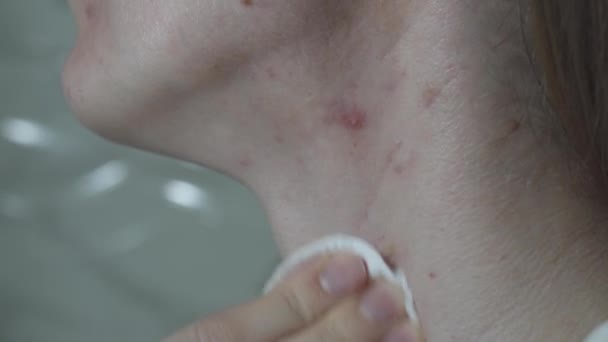 Lány Szivaccsal Nyakán Tisztítja Bőrt Egy Akne Problémákkal Küzdő Olajos — Stock videók