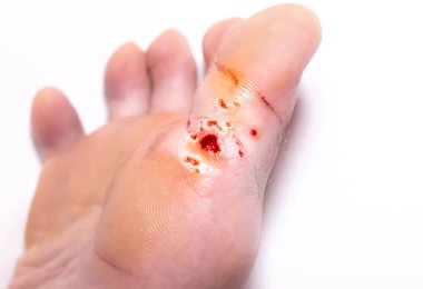 Siğillerin lazerle çıkarılmasından kalma izler. Kanama yarası. Yaya olarak bulaşıcı deri hastalığı. Tıbbi tedavi fotoğrafı..