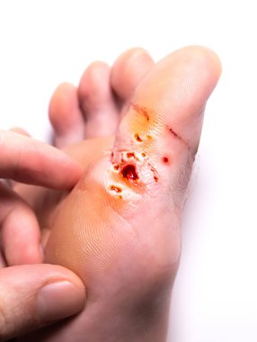 Siğillerin lazerle çıkarılmasından kalma izler. Kanama yarası. Yürüyerek bulaşıcı deri hastalığı. Tıbbi tedavi fotoğrafı..