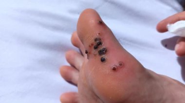 Siğillerin lazerle çıkarılmasından kalma yaralar. Yürüyerek bulaşıcı deri hastalığı. Parmak ucunda pamuk tutan adam. Tıbbi tedavi videosu. Kanla yaralanmış bacak. Yakın plan..