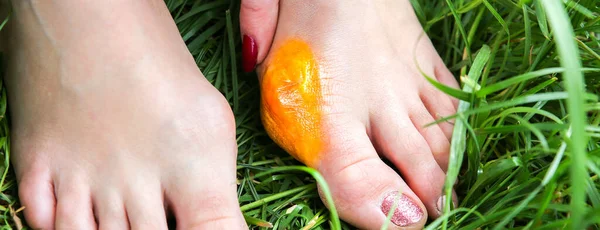 Bunion Piede Della Donna Donna Sta Applicando Crema Alluce — Foto Stock