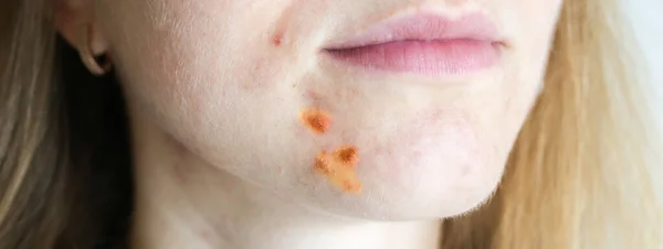 Woman\'s oily skin with acne problems. Scars and wounds on the face. Health care photo.