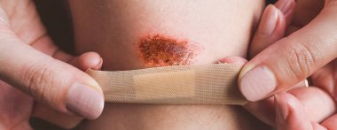 Kadının dizinde sıyrık var. Kız yaralı bacağına kırmızı bir yarayla antiseptik bant yapıştırıyor. Tıbbi tedavi.