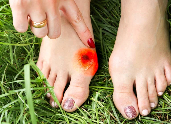 Bunion on the woman's foot. Woman is applying cream on big toe.