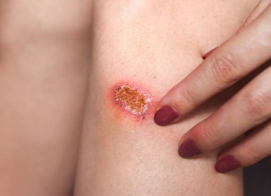 Kadının dizinde sıyrık var. Kız yaralı bacağına kırmızı bir yarayla krem sürüyor. İlk yardım için tıbbi tedavi.