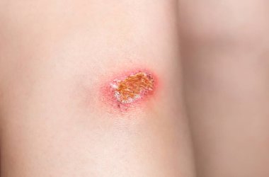 Kadının dizinde sıyrık var. Kırmızı bir yarayla yaralı bir bacak. İlk yardım için tıbbi tedavi.