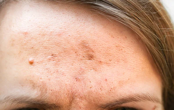 Big birthmark on the girl\'s skin. Medical health photo. Woman\'s face with wartpapilloma.